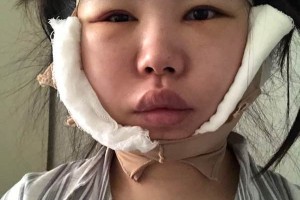 鄭大一附院有整形科怎么樣？下頜角術(shù)真實案例|醫(yī)生推薦