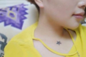 浙江張小紅美容醫(yī)院下頜角較新價(jià)格表|案例分享