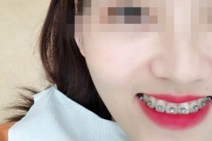 青島優(yōu)諾博士口腔醫(yī)院牙齒矯正怎么樣？恢復(fù)圖分享