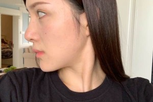 廈門第一醫(yī)院美容科下頜角怎么樣？術(shù)前術(shù)后對(duì)比圖！