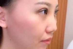 廈門第一醫(yī)院整形科哪位醫(yī)生好？埋線雙眼皮術(shù)后果&價(jià)格表