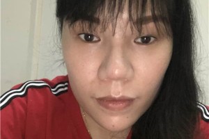 無錫人民醫(yī)院膨體隆鼻怎么樣？真實案例分享！