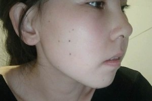 協(xié)和醫(yī)院整形科硅膠隆鼻價位？真實案例分享！