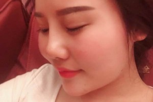 深圳北大醫(yī)院美容科膨體隆鼻好嗎？真實(shí)案例分享！