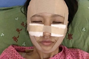 上海安縵醫(yī)療怎么樣？面部填充成功案例測評！