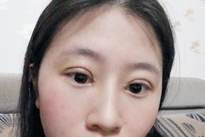 南昌大學美容醫(yī)院切開雙眼皮是正規(guī)嗎？附果圖&價格表