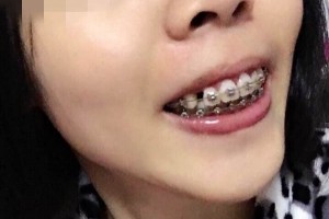 北京億大口腔醫(yī)院牙齒矯正怎么樣？附較新價格表！