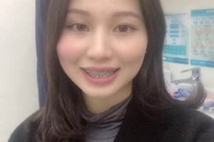 濟(jì)南圣貝口腔醫(yī)院牙齒矯正怎么樣/真實(shí)案例對比！