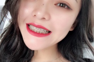 重慶美奧口腔醫(yī)院怎么樣？附醫(yī)院信息+正畸果圖