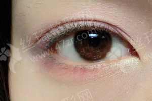 西安做雙眼皮醫(yī)生排行榜醫(yī)生優(yōu)勢簡介|醫(yī)生優(yōu)勢介紹，雙眼皮項(xiàng)目術(shù)后體驗(yàn)感受點(diǎn)評